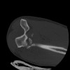 SPORK, NICO - 22.03.1976 - 02.08.2022 - CT obere Extremität - 17:59:38